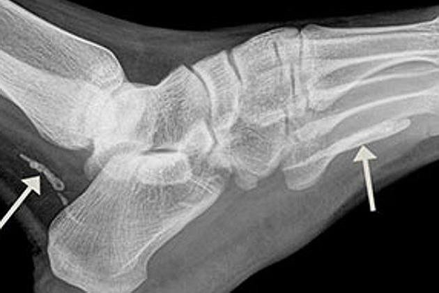 Mengerikan, Cacing Sepanjang Satu Meter Bersarang di Kaki Pria ini  